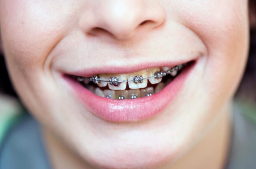  What is the Right Age for Braces? 
