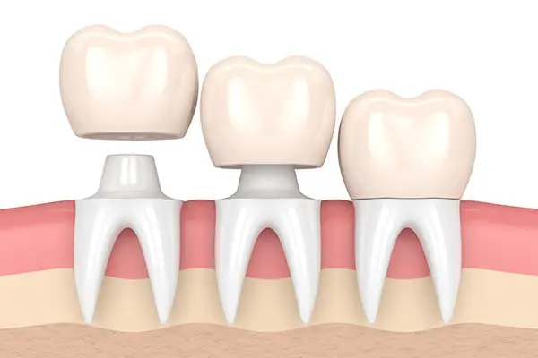 dental-crowns